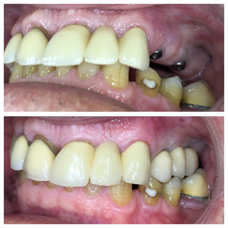 dental-implants-s1