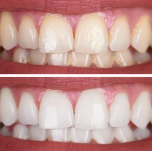 Close-up Of A Smiling Woman's Teeth Before And After Whitening